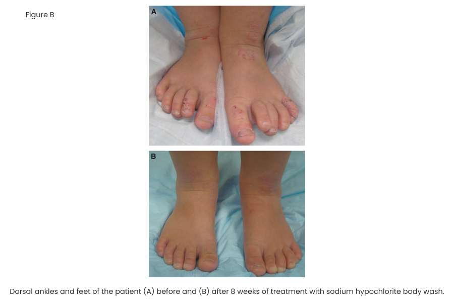 Figure B: Cln bodywash results