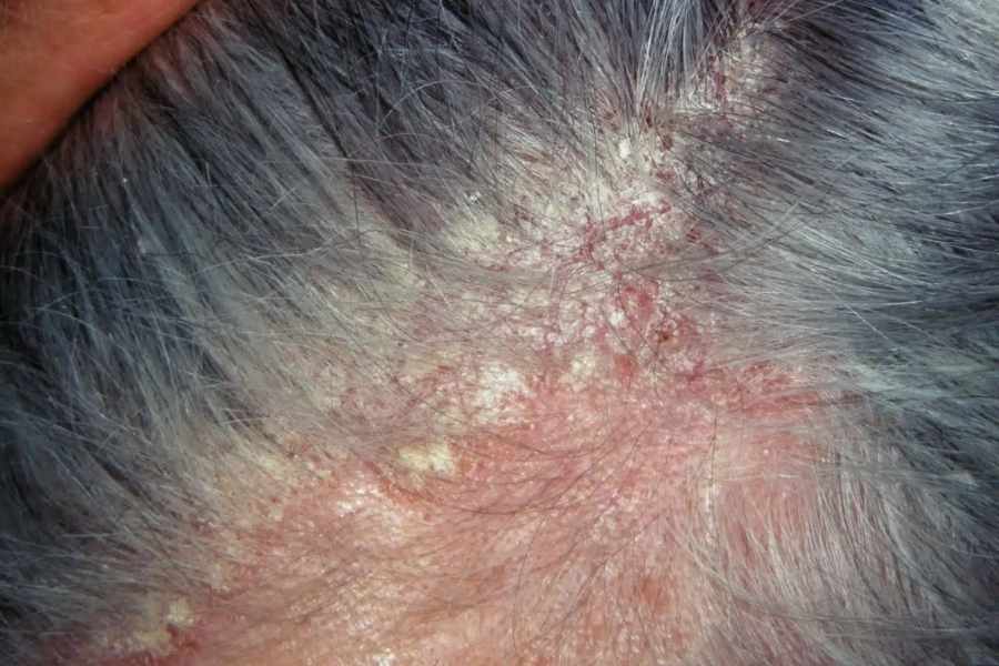 seborrheic dermatitis SCALP