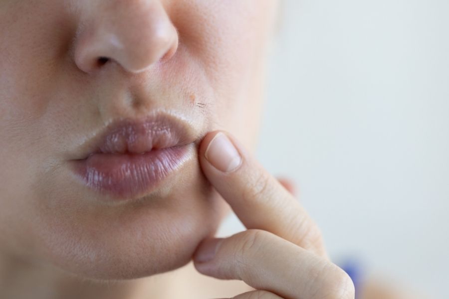 permanent facial hair removal for women